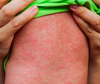 O sarampo é uma doença infecciosa aguda, de natureza viral, transmitida pela fala, tosse e espirro