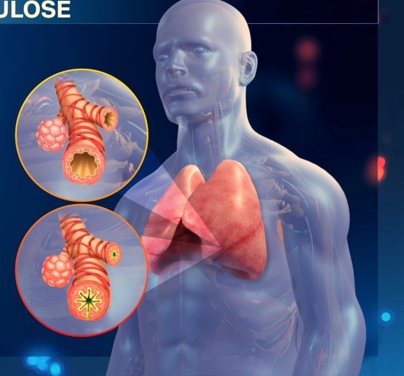 AÇÕES DE EDUCAÇÃO EM SAÚDE PARA A PREVENÇÃO DA TUBERCULOSE HUMANA